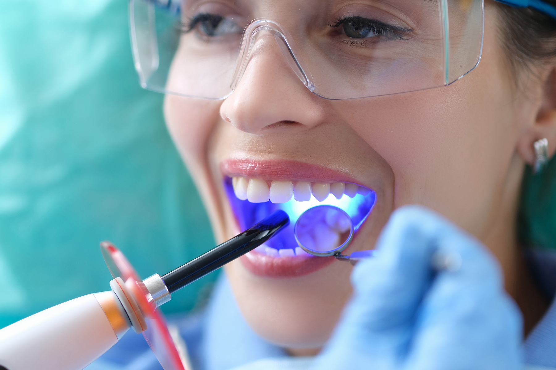 Composite Dental Bonding in Castle Rock, CO